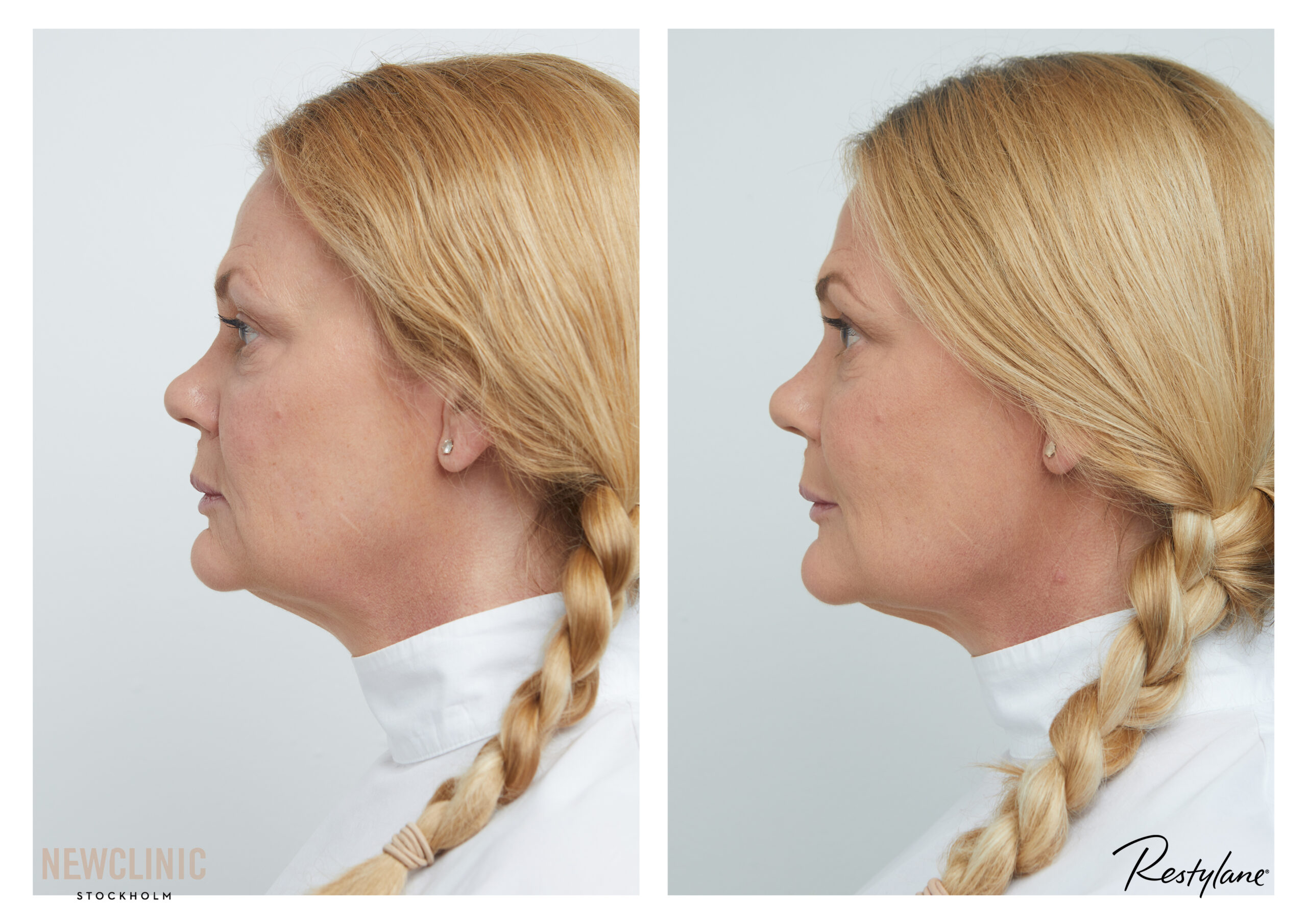före och efter bilder skönhetsbehandlingar stockholm stureplan